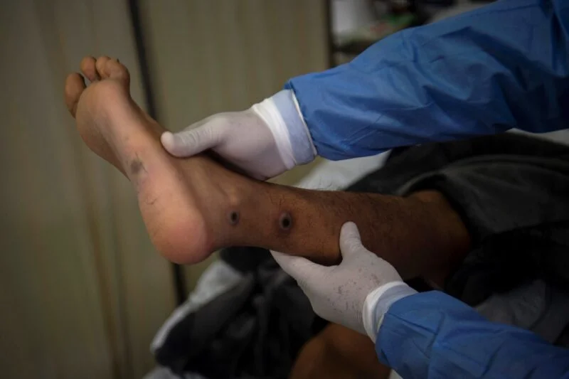 Un médico revisa a un paciente con llagas causadas por una infección de viruela del simio.