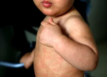 Alerta epidemiológica en varios países de la región por casos de sarampión en EEUU y México 