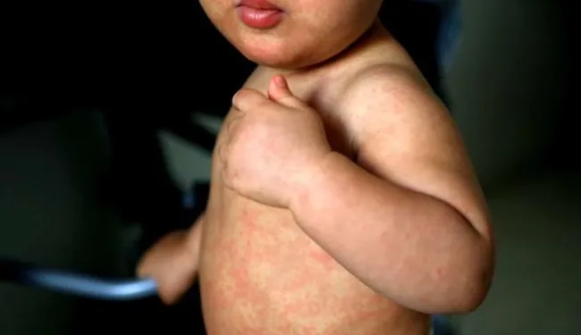 Alerta epidemiológica en varios países de la región por casos de sarampión en EEUU y México