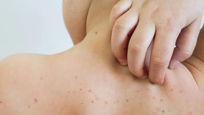 Belice confirma sus primeros casos de sarampión en más de tres décadas: pacientes regresaban de México