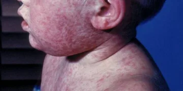 Nicaragua activa plan nacional ante alerta internacional por sarampión