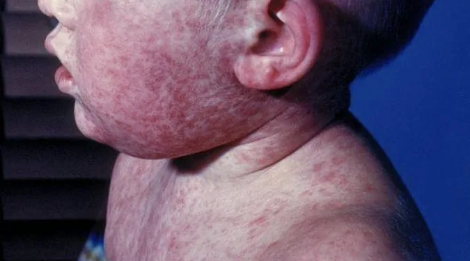 Nicaragua activa plan nacional ante alerta internacional por sarampión