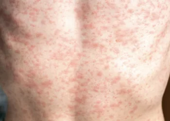 Guatemala reporta un sexto caso confirmado de sarampión en menor de 14 años