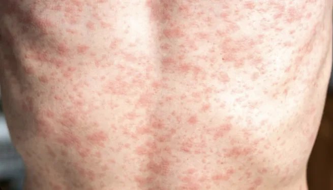 Guatemala reporta un sexto caso confirmado de sarampión en menor de 14 años