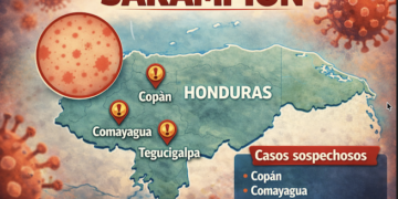 Honduras detecta cuatro casos sospechosos de sarampión tras 27 años sin contagios locales