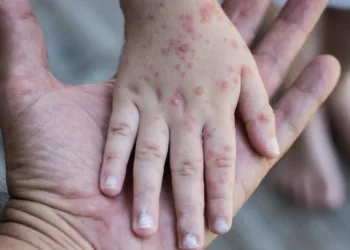 Más de dos mil personas de toda Centroamérica participaron en evento donde ocurrió el contagio de sarampión en Guatemala