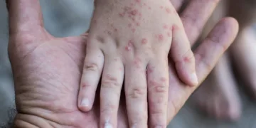 Más de dos mil personas de toda Centroamérica participaron en evento donde ocurrió el contagio de sarampión en Guatemala