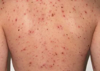 Sarampión en Centroamérica: Guatemala, Honduras y El Salvador activan alertas sanitarias