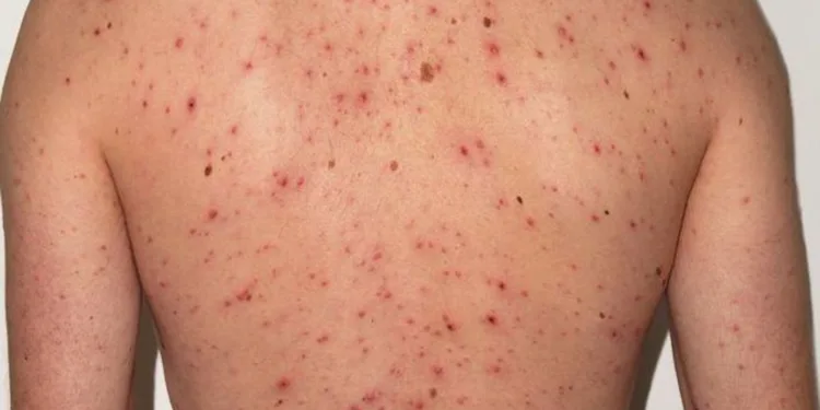 Sarampión en Centroamérica: Guatemala, Honduras y El Salvador activan alertas sanitarias