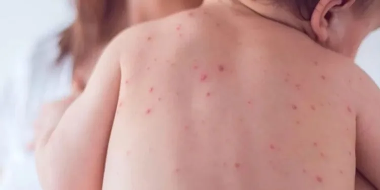 Guatemala eleva a 225 los casos de sarampión y el brote ya alcanza 17 departamentos