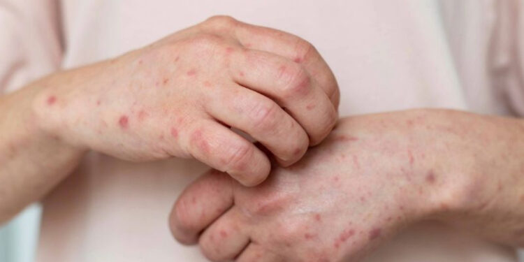 Sarampión en Centroamérica: Guatemala es el epicentro del brote y la región refuerza vigilancia y vacunación