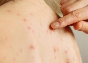 Sarampión se extiende por Guatemala y ya suma 868 casos confirmados en casi todo el país