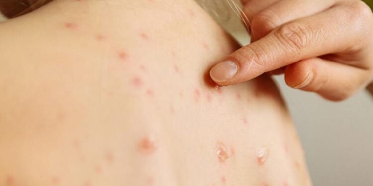 Sarampión se extiende por Guatemala y ya suma 868 casos confirmados en casi todo el país