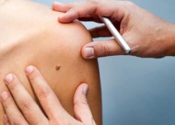 Alerta en El Salvador: el cáncer de piel podría afectar a más del 5% de la población