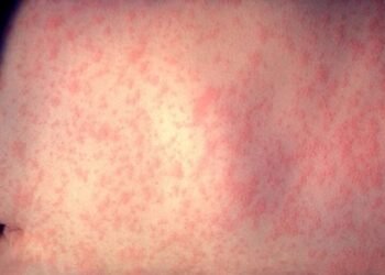 Belice confirma caso de sarampión venido de Guatemala y refuerza vacunación nacional