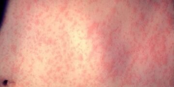 Belice confirma caso de sarampión venido de Guatemala y refuerza vacunación nacional