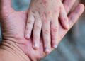 El 83% de los casos de sarampión en El Salvador corresponden a personas sin vacuna o que desconocen su estado