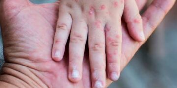 El 83% de los casos de sarampión en El Salvador corresponden a personas sin vacuna o que desconocen su estado