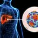 EE.UU. alerta por brote de hepatitis A en Costa Rica